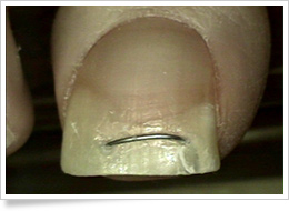 巻き爪治療の写真